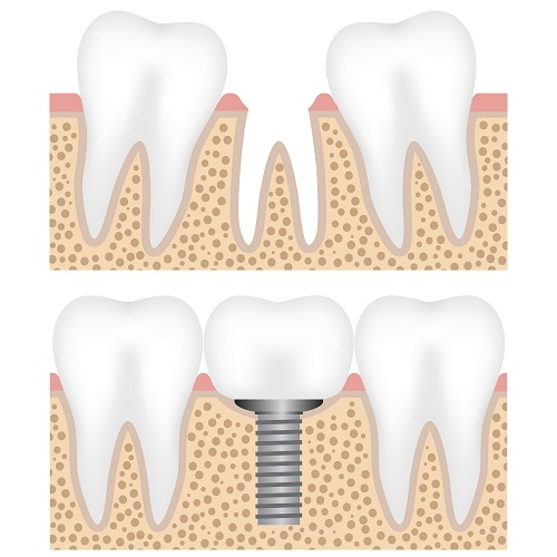 Implant dentist in Airdrie