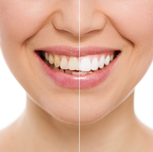 Smile depicting before & after of teeth whitening