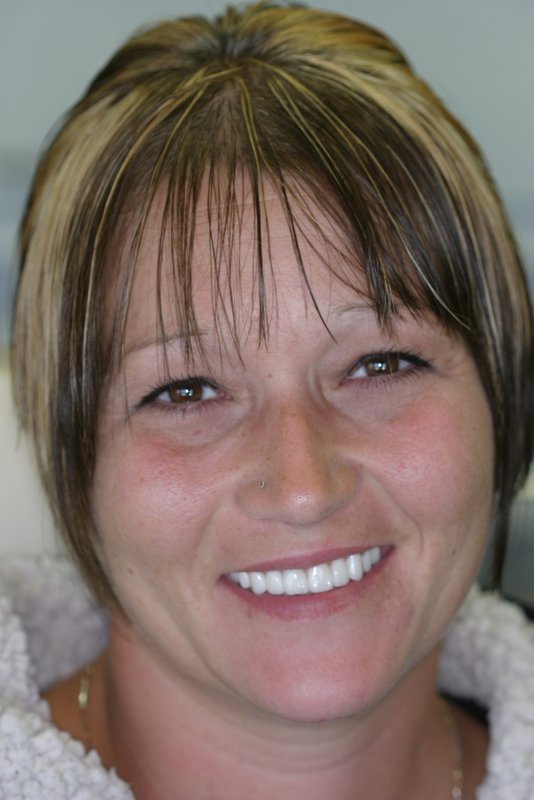 Smile Makeover Patient After- Kimberly