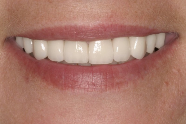 Close Up Smile Makeover Patient After- Kimberly