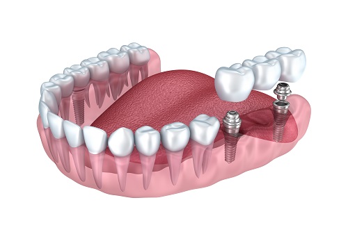 Dental implants to replace missing teeth