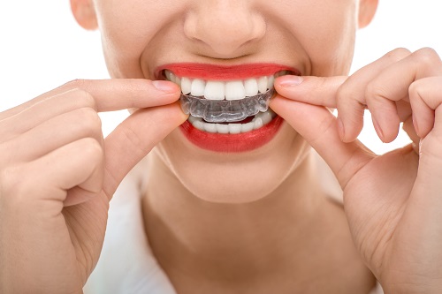 Invisalign services in Calgary AB