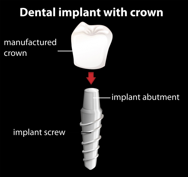 Dental Implant Process - Calgary