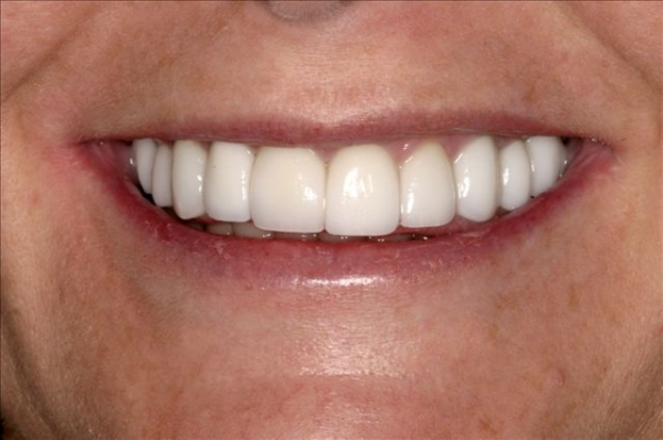 Smile Makeover Patient 2 After Calgary