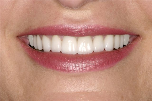Close Up of Smile Makeover Patient After- Joanne