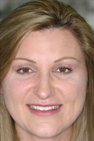 Smile Makeover Patient Before - Joanne
