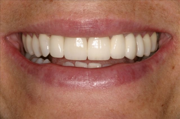 Alberta Smile Makeover Patient-Lisa After