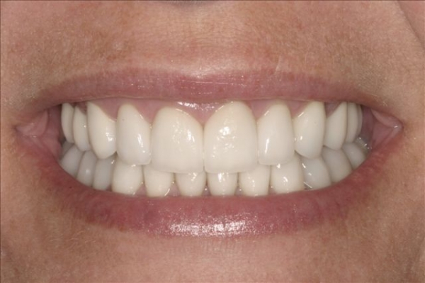 Smile Rejuvenation Patient After Calgary