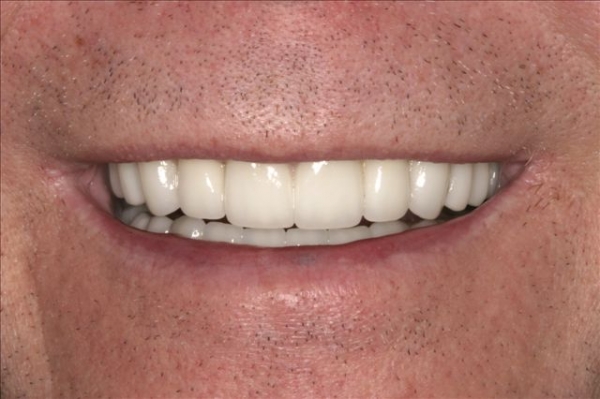 Smile Rejuvenation Patient 2 After Calgary