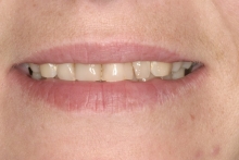 Close Up Smile Makeover Patient Before - Kimberly