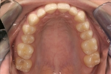 Close Up After Clear Aligners-Megan