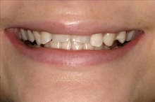 Clear Aligners Patient Before - Megan