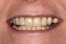 Smile Makeover Patient 2 Before Calgary