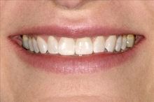 Close Up of Smile Makeover Patient Before - Joanne