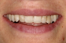 Alberta Smile Makeover Patient-Lisa Before
