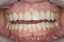 Teeth close Up of After Smile Makeover-Mimi