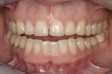 Teeth close Up of Before Smile Makeover-Mimi
