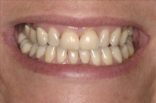 Smile Rejuvenation Patient Before Calgary