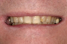 Smile Rejuvenation Patient 2 Before Calgary