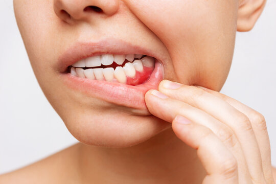 peridontal disease