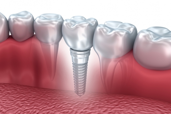 dental implant process