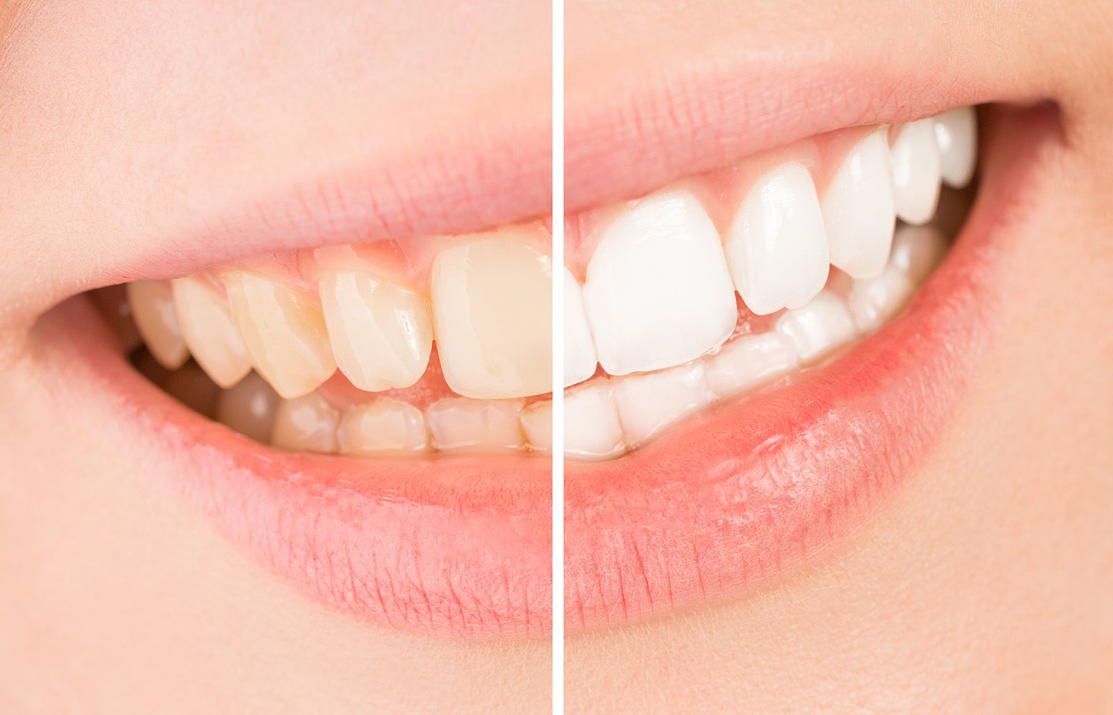 Tooth stain before & after