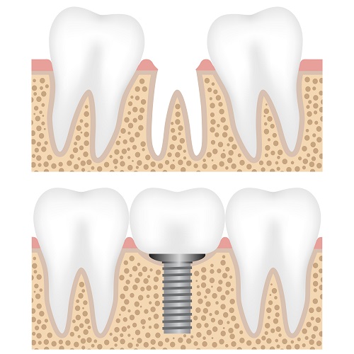 Implant-dentistry-airdrie